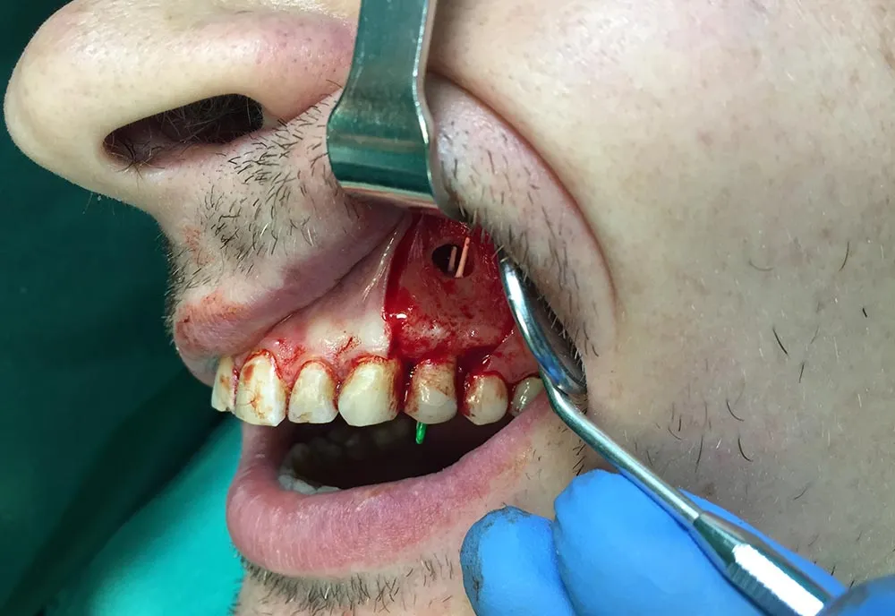 Apicoectomy
