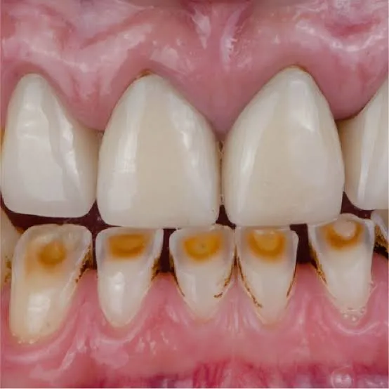 Attrition Treatment in Noida