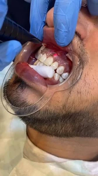 Black Gums Treatment