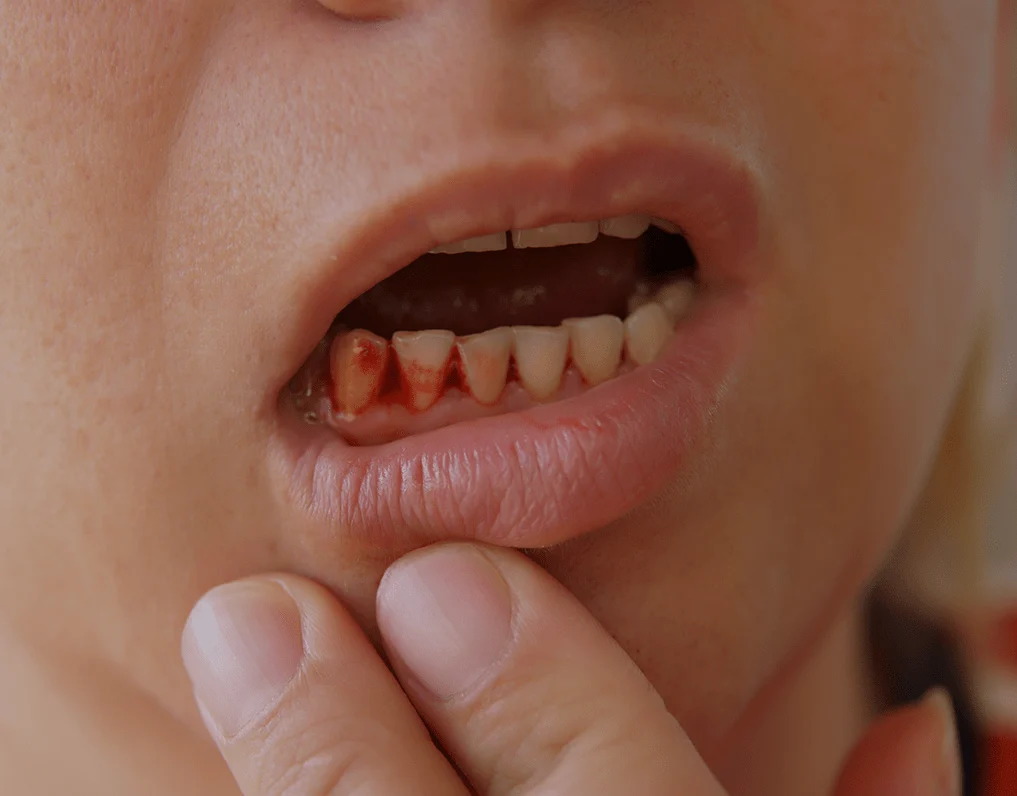 Bleeding Gums Treatment