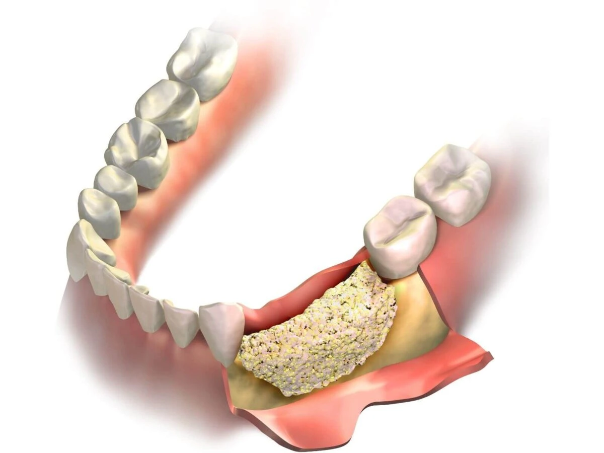 Bone Loss Treatment