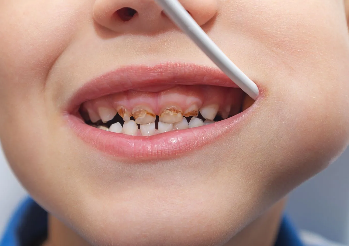 Childhood Cavity Treatment and Dental Fillings