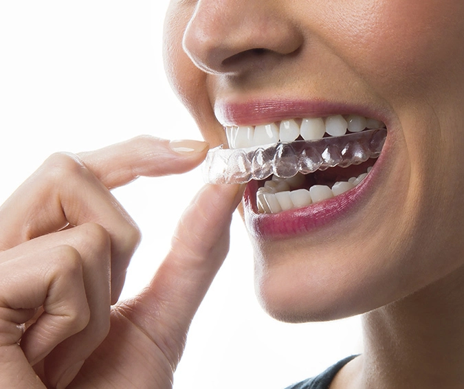 Clear Aligners Treatment in Noida