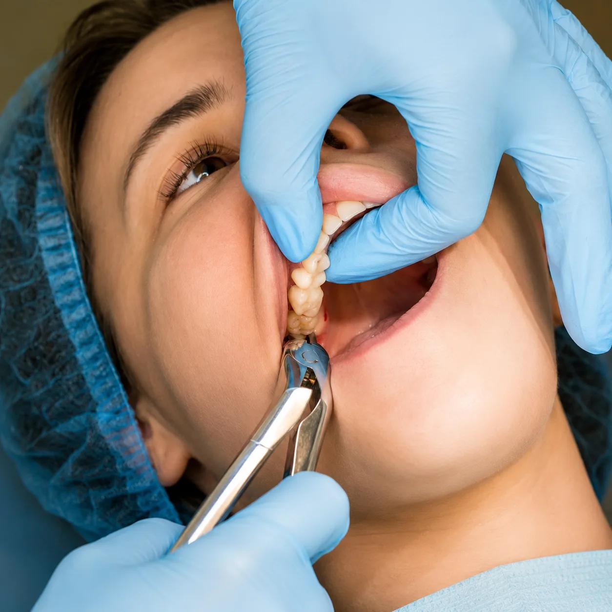 Complex Tooth Extraction
