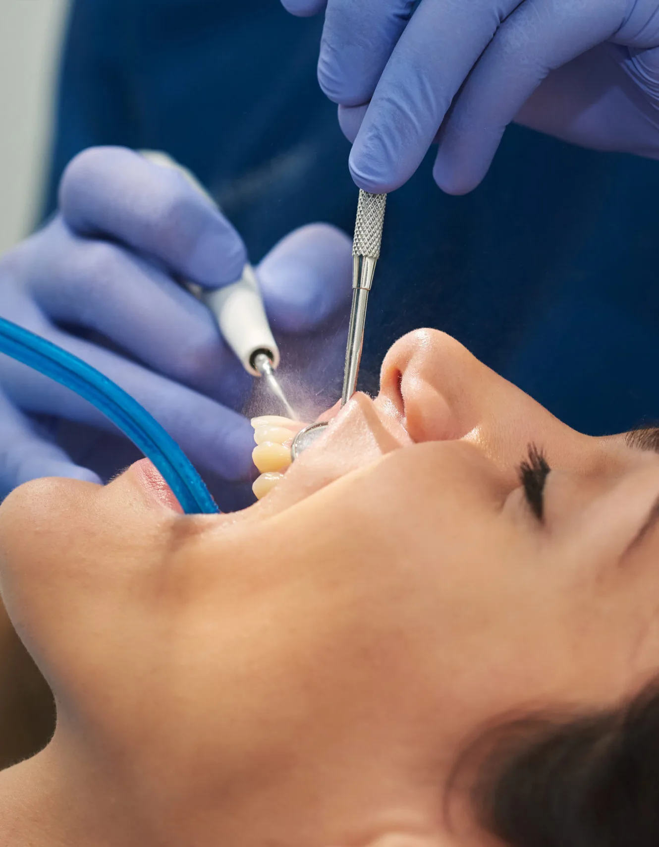 Deep Teeth Cleaning