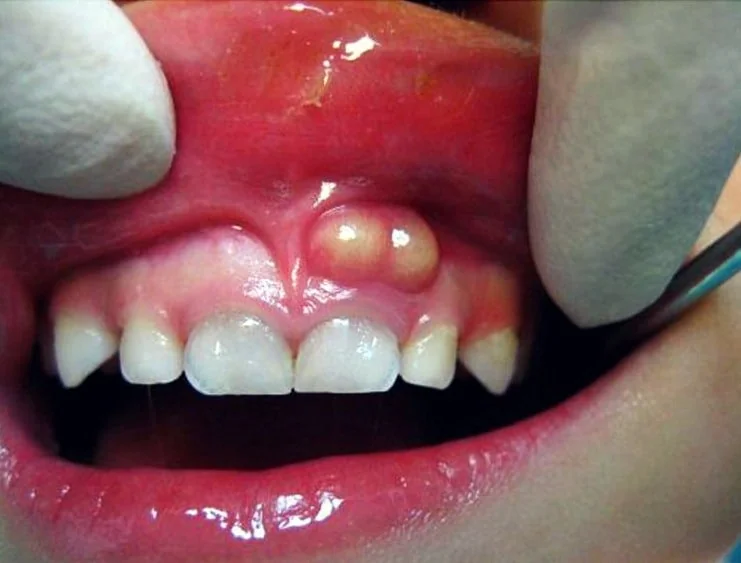 Dental Abscess Treatment
