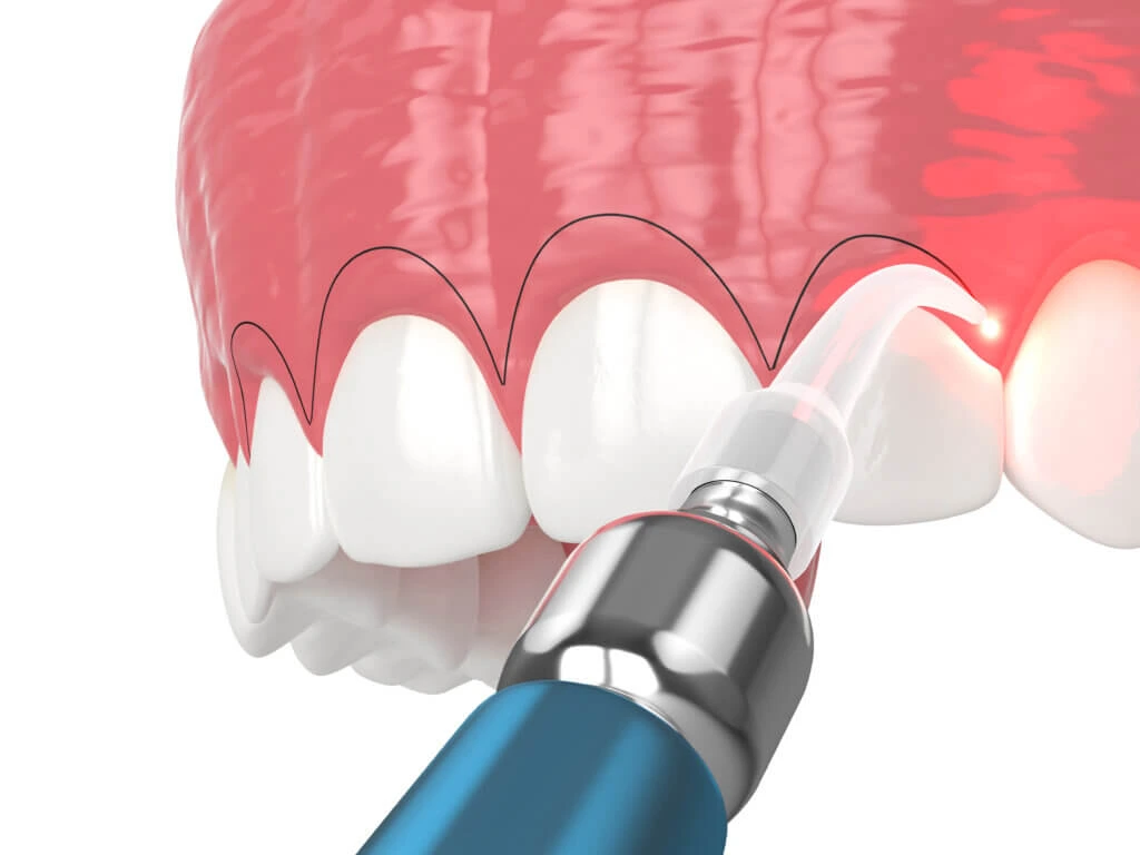Gum Contouring