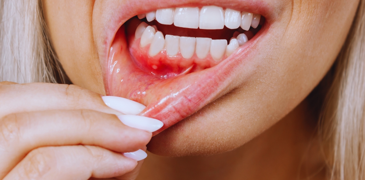 Gum Infection Treatment