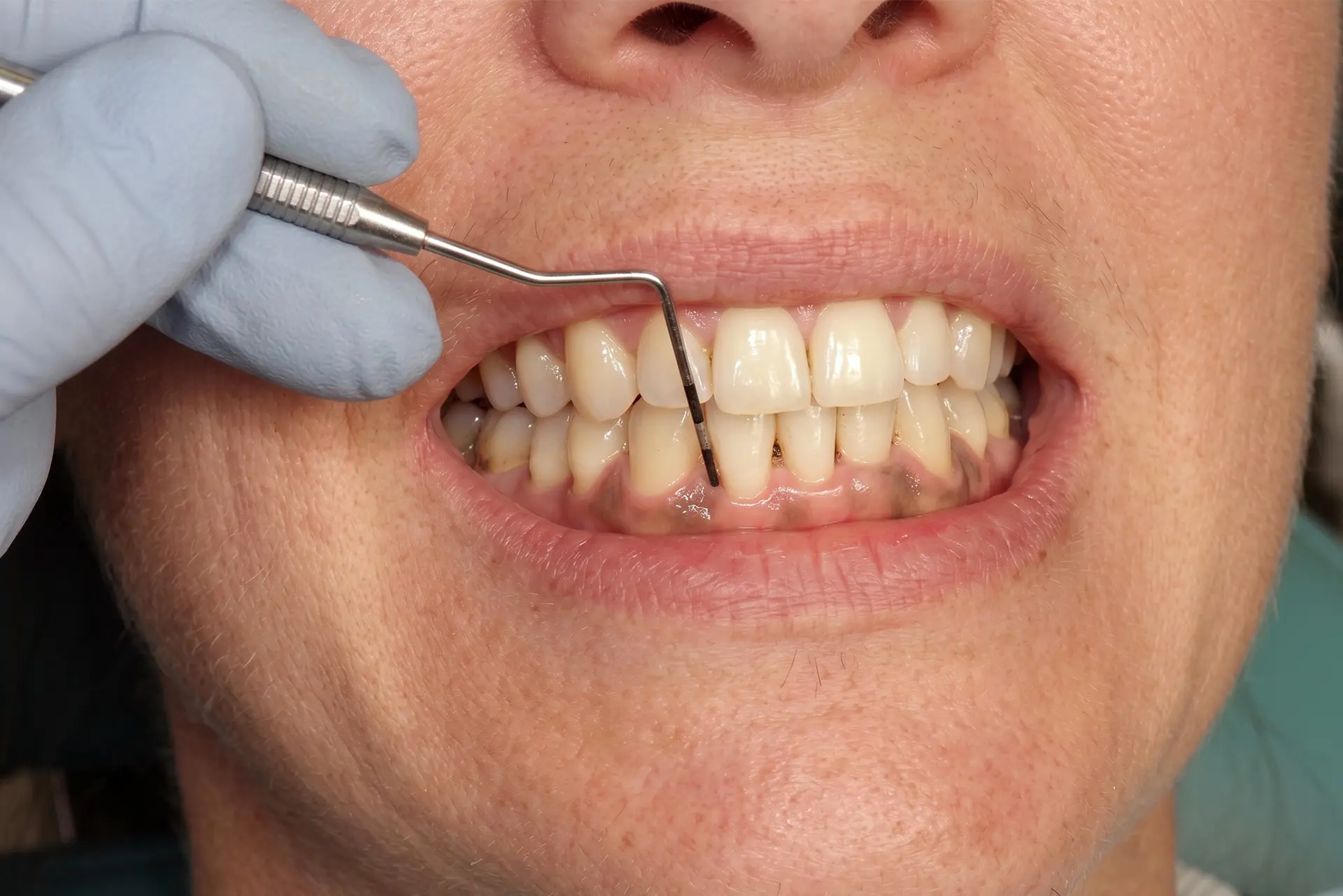 Gum Pocket Treatment