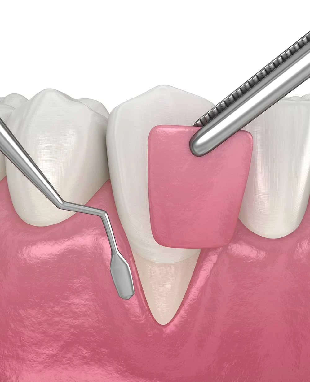Gum Recession Treatment