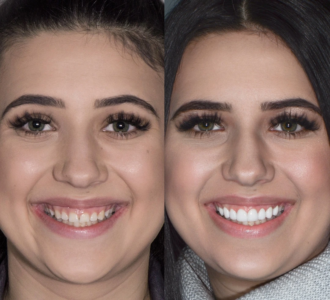 Gum Reshaping