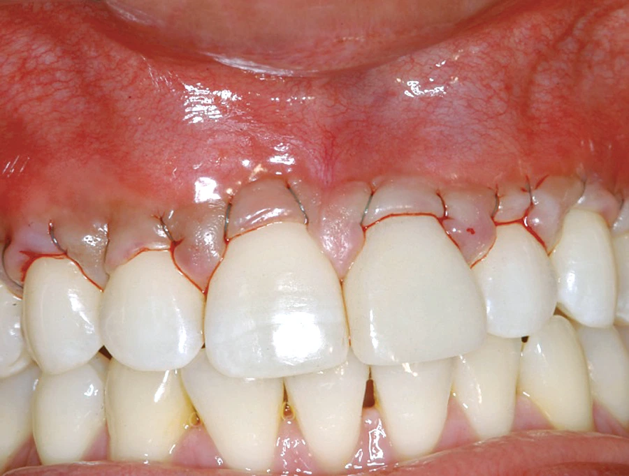 Gum Surgery