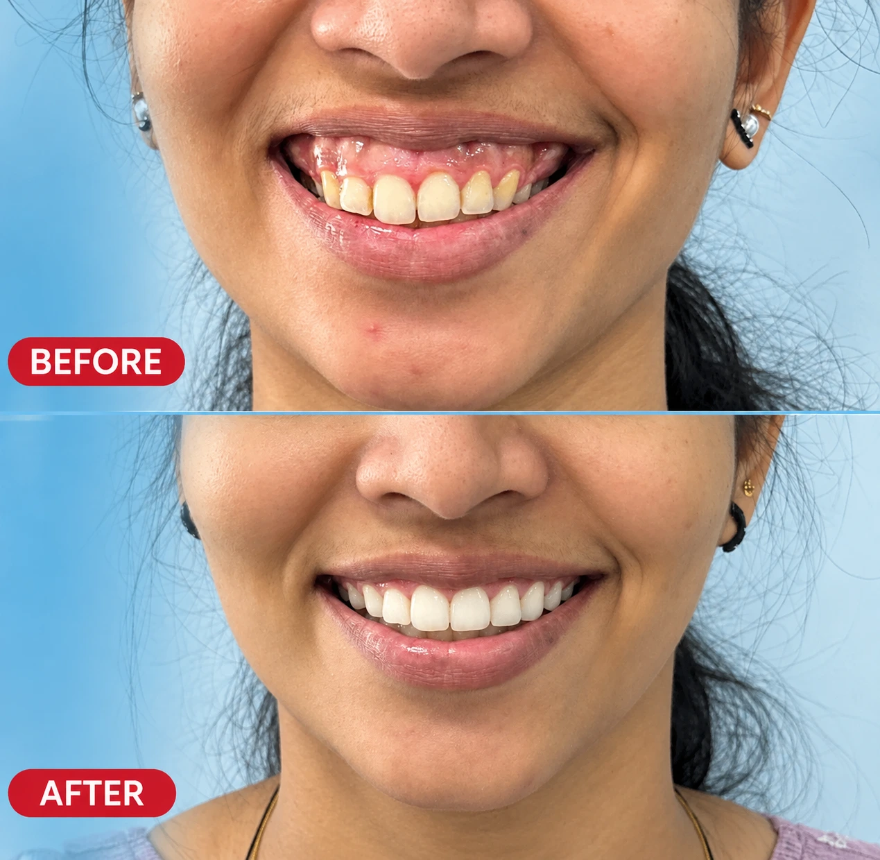 Gummy Smile Treatment