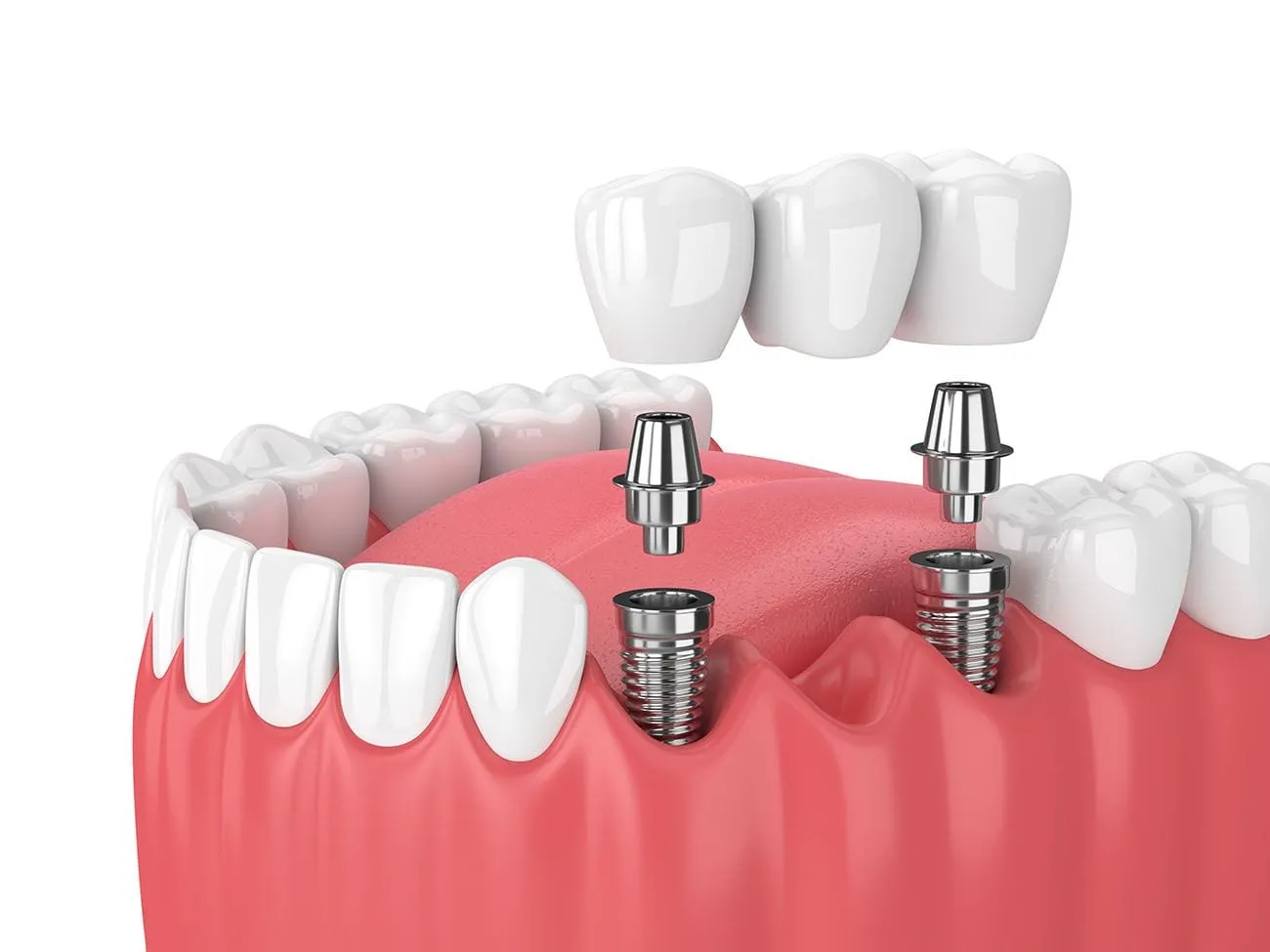 Implant Supported Crowns and Bridges in Noida