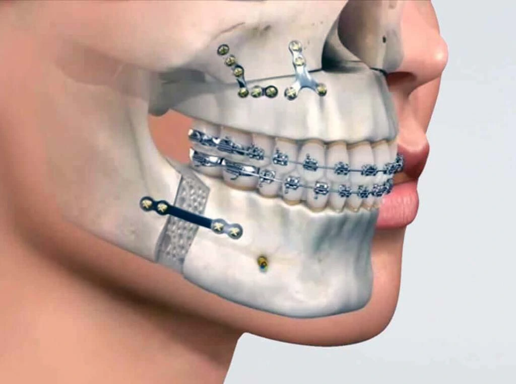 Jaw Surgery