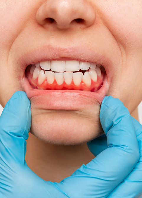Loose Teeth Due to Gum Disease