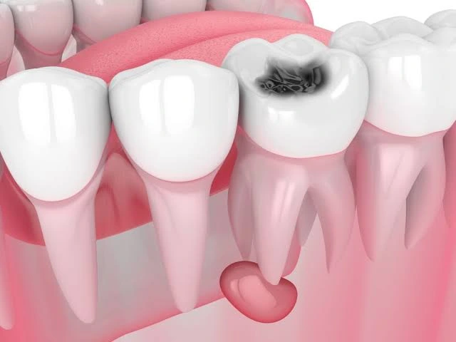 Oral Cyst Removal
