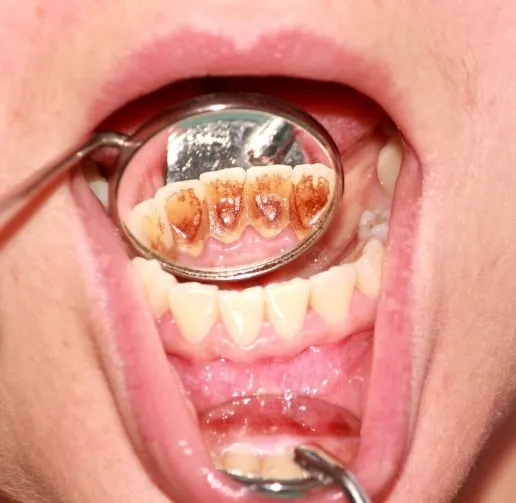 Periodontal Disease Treatment