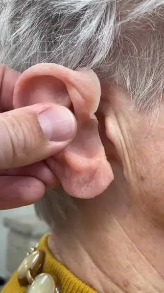 Prosthetic Ear Services in Noida