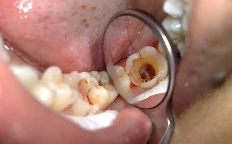 Pulp Therapy for Infected Milk Teeth