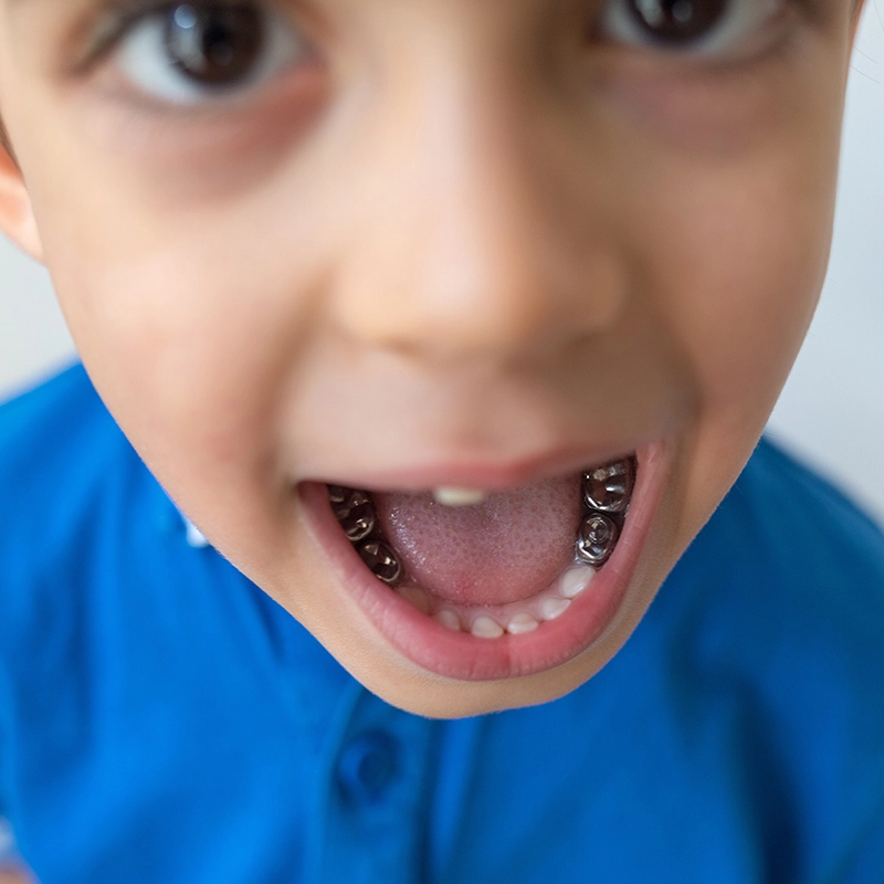 Stainless Steel Crowns for Primary Teeth