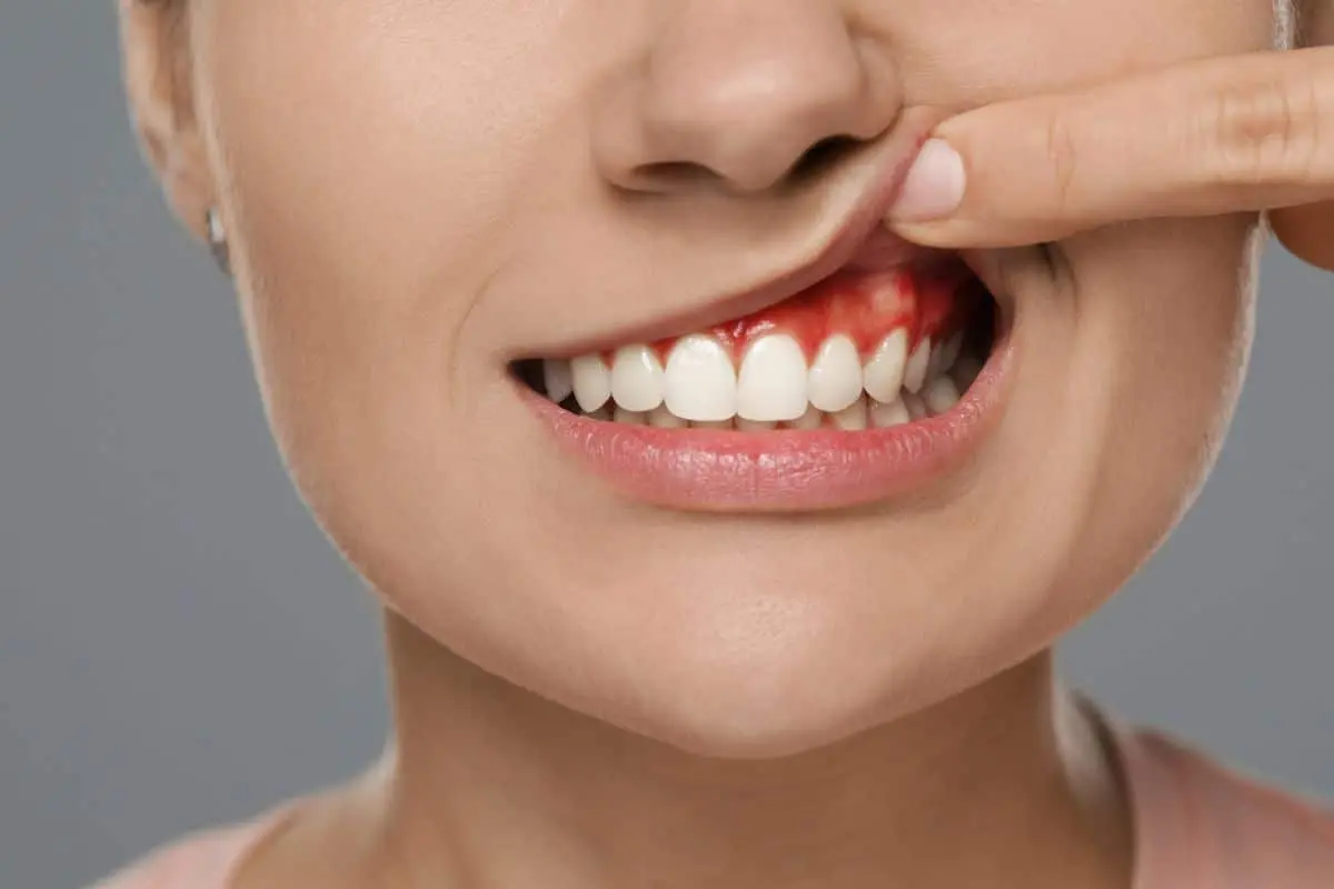 Gingivitis Treatment