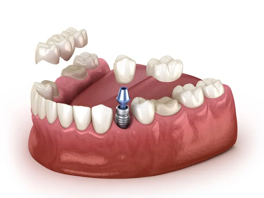 Dental Crowns and Bridges