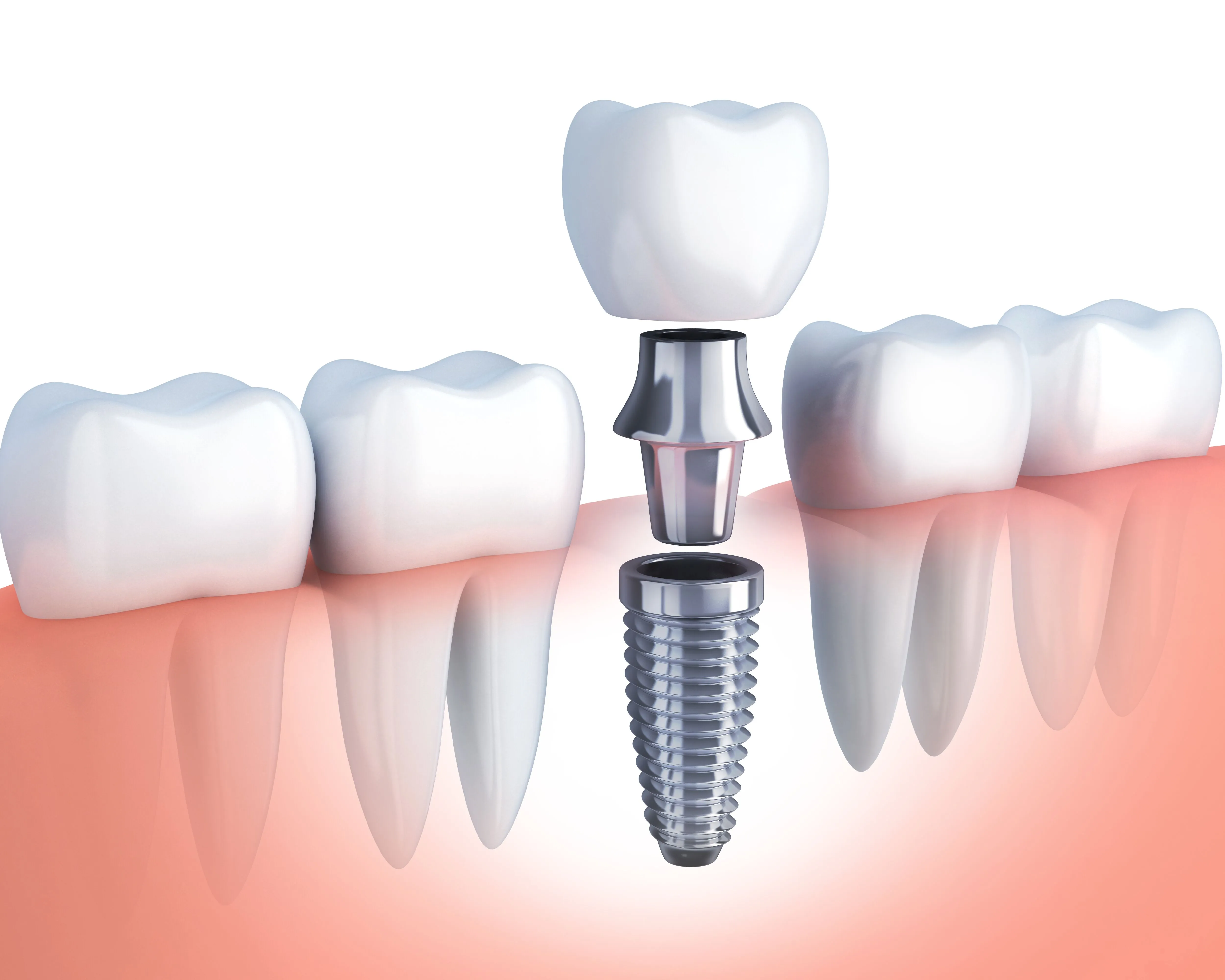 Dental Implants in Sector 104 Noida