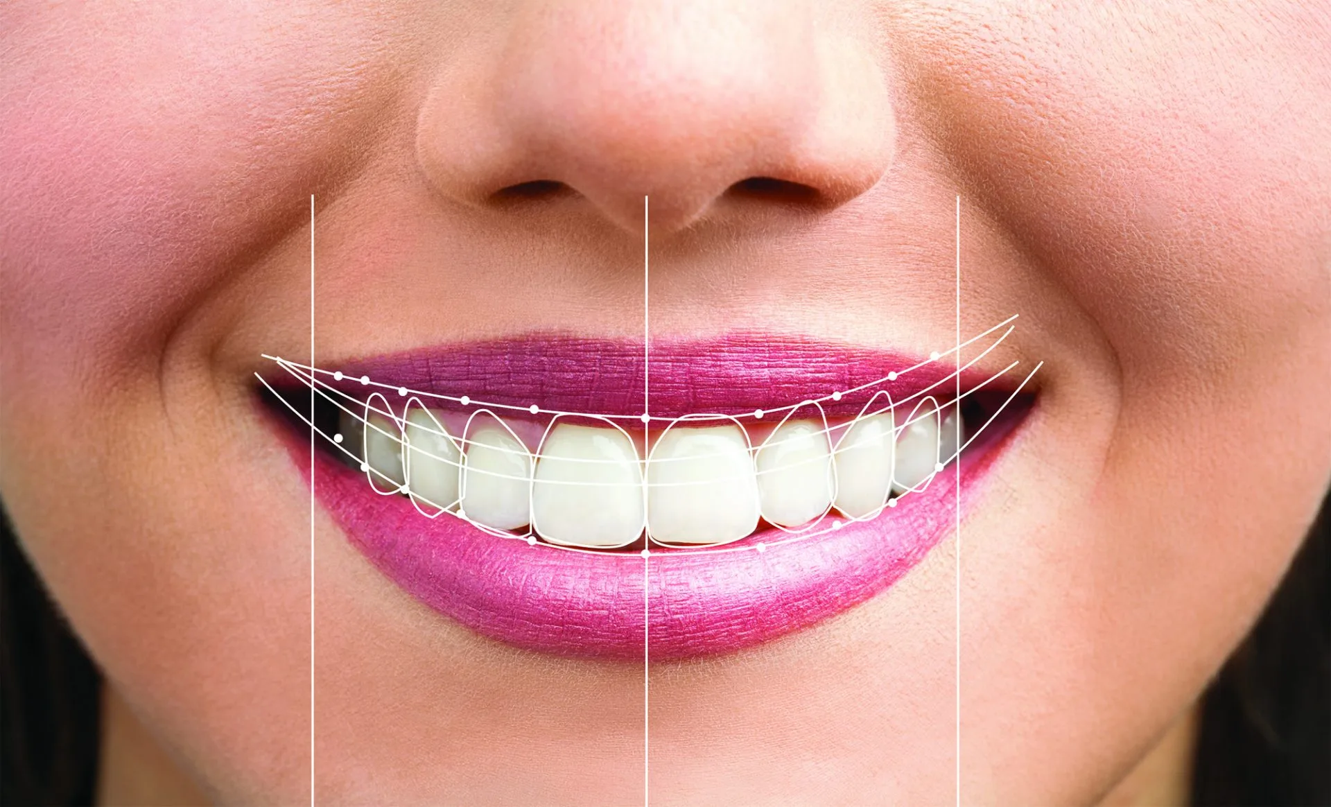 Smile Design and Smile Makeover in Noida