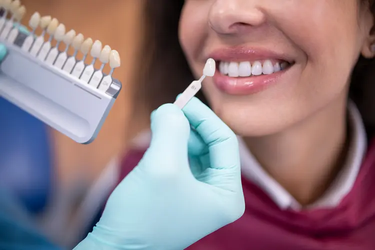 Dental Veneers in Sector 104 Noida