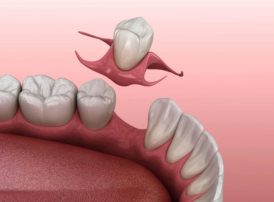 Replacement of Missing Teeth