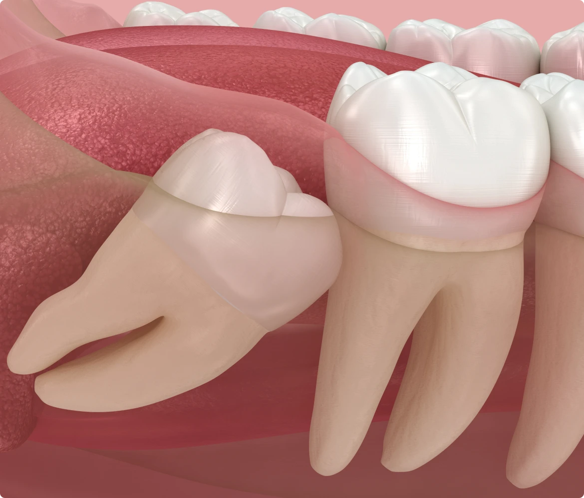 Wisdom Tooth Removal